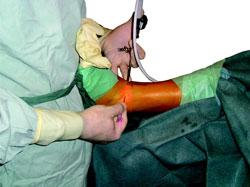 Arthroscopic debridement. This surgery may be helpful in the early stages of arthritis.