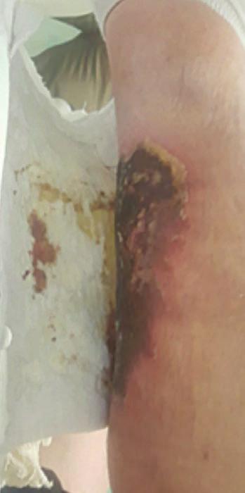 Sharp debridement and moistened was used in a protocol of care for four days (Figure f).
