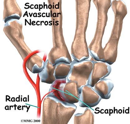 It is the most commonly fractured carpal bone. This is probably because it actually crosses two rows of carpal bones, forming a hinge.