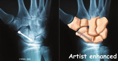 The screw holds the scaphoid firmly until it heals. Bone Graft Method Your surgeon may use a bone graft.