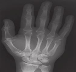 The hand Hand injuries are common in spor t, with ball-handling sports, gymnastics and fighting both in the ring and recreationally producing man y of these injuries.