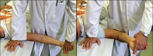 60 pts with 1 st CMC OA (65-90yrs old) Treatment Gp: radial nerve sliders, median n
