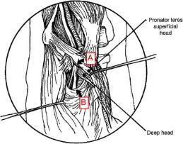 Pronator Teres Syndrome History Median nerve compression btw heads of pronator teres Paresthesias digits 1-3 increased w/activity Weakness in forearm and hand mm (Med nerve) Physical Exam (+)TTP prox