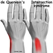 Intersection Syndrome Lateral Wrist Pain Differential Diagnosis Thumb CMC Arthritis Scaphoid Fracture Radial Styloid Fracture De Quervain s Syndrome Superficial Radial Sensory Nerve Injury Treatment