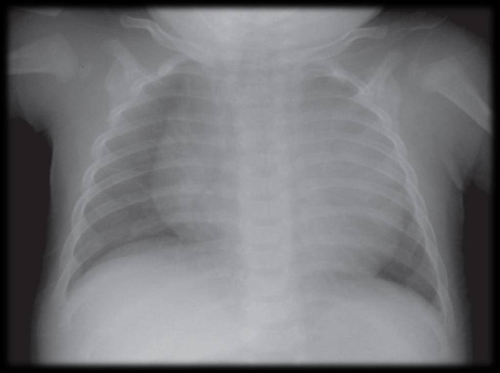 CARDIOMEGALY IN INFANTS All images Learning