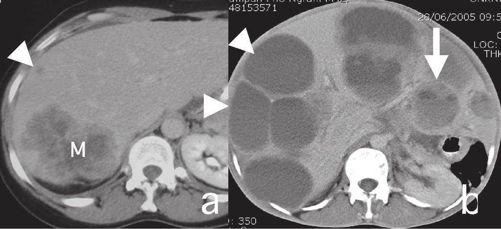 Axial contrast enhanced CT scan demonstrate a) large liver metastasis (M) and a smaller hypovascular metastasis (arrowhead). b.