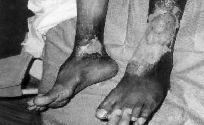 15 years duration Patient II Figure 6: Lt. Leg after LD Muscle cover ulcers.