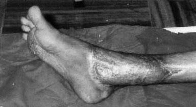 Reddy KMM, et al. Figure 7: Rt. leg after Gracilis Muscle cover Figure 8: Rt.