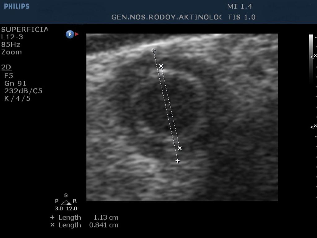 Conclusion Any patient who presents to the emergency department with abdominal pain and is suspected to have appendicitis, could benefit from sonographic imaging of their appendix.