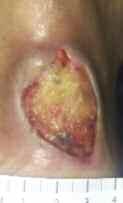 Debride all nonischemic wound infections, best performed by sharp excision of the superficial infected fibrinous and nonviable tissue.