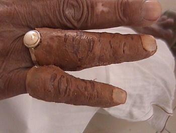 (Figure: 9 Final finger prosthesis in place) To complete the prosthesis, appropriate sized artificial nails were adapted into place & the nails were shaped according to the nails of the natural