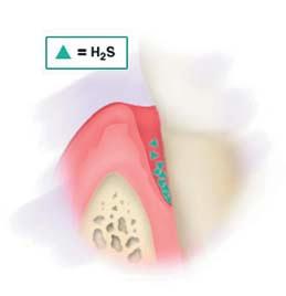 Introduction Volatile sulphur compounds (VSC) are produced through the putrefaction activities of microorganisms on appropriate substrate components of dental plaque, debris adherent to mucous