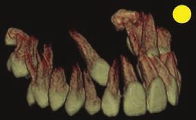 horizontal canines) need a stronger anchor to be moved closer to the occlusal plane before the engagement into a self-ligating system (not shown).