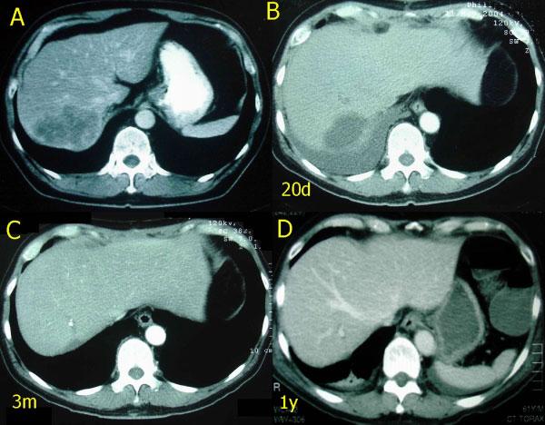 Bisegmentectomy VII VIII 341 Fig. 5. Case # 1. A: Preoperative CT scan shows a large tumor involving segments 7 and 8 of the liver.