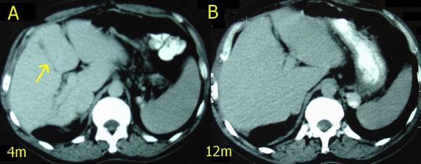 C: Late CT scan (3 months) showing complete regeneration of the liver; the area of resection is still present.