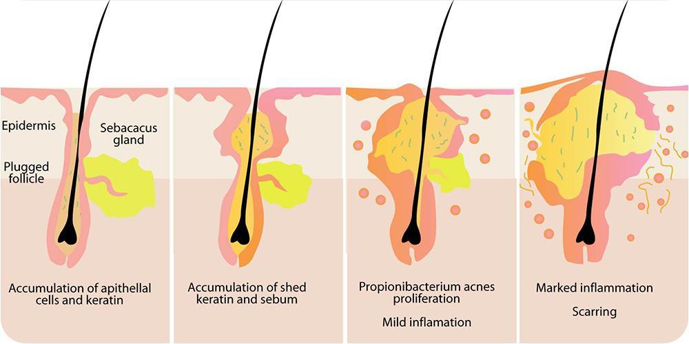 Causes for Acne Hormonal follicular keratinization