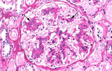 IgA Nephropathy Kidney biopsy reveals diffuse