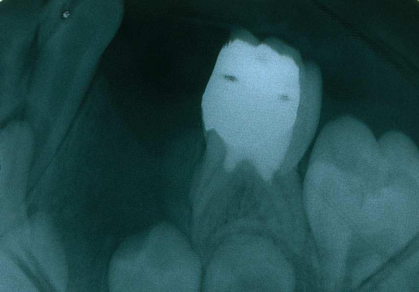 Journal of Dentistry, Tehran University of Medical Sciences Toomarian et. al Figure 4. Periapical radiograph 3 months after surgery resorptions.