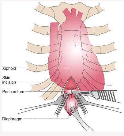 Cardiac trauma (diagnosis) Subxiphoidal exploration (Pericardial window) Definitive diagnostic test in stable patient Good test to rule out tamponade in patients who do not have tamponade Positive