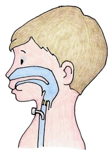 Why does your child have a trach?