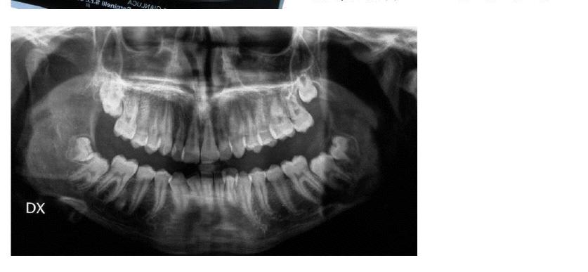Treatment of a Class II Division 2 Patient with Severe The Open Dentistry Journal, 2013, Volume 7 111 Fig. (4). Cephalometric values and panoramic radiograph at the start of treatment.