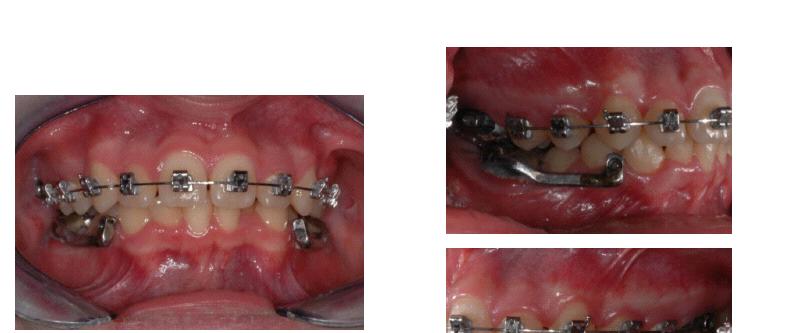 112 The Open Dentistry Journal, 2013, Volume 7 Paduano et al. Fig. (6). Herbst miniscope in place. Fig. (7). Extraoral photographs following Herbst appliance.