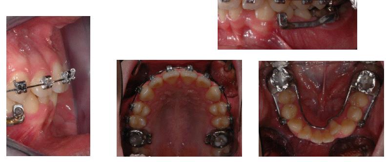 In this case, we used a fixed no compliance functional appliance (Herbst miniscope, American Orthodontics, Sheboygan, US) due to the well-known scarce cooperation