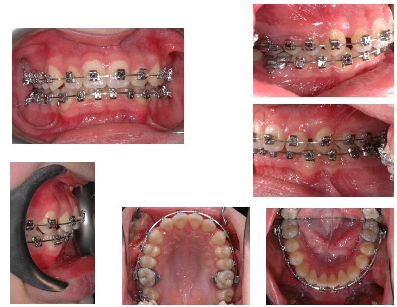 Treatment of a Class II Division 2 Patient with Severe The Open Dentistry Journal, 2013, Volume 7 113 Fig. (8). Intraoral photographs during treatment.0.019 x0.025 Stailess steel archwires in place.