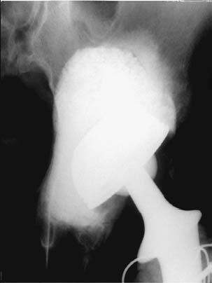 HYDROXYAPATITE IN REVISION OF HIP REPLACEMENTS WITH MASSIVE ACETABULAR DEFECTS 89 Figure 2a Immediately after operation in a 65-year-old woman. Figure 2b Four months later.