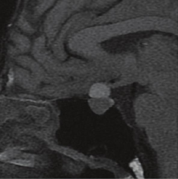 2 Case Reports in Neurological Medicine Pituitary adenoma (c) (d) Figure 1: Sagittal T1-weighted MRI of the head shows a suprasellar, high-intensity mass suspected to represent RCC.
