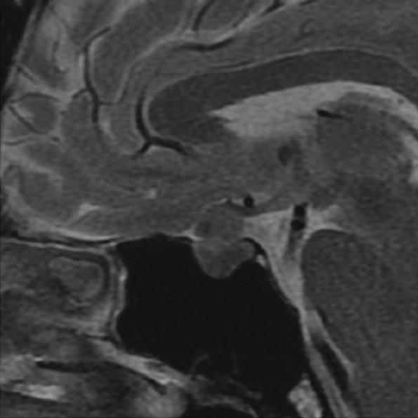 In contrast, the normal pituitary gland shows strong enhancement. (d) Contrast-enhanced coronal MRI shows slight compression of the optic chiasma by RCC.