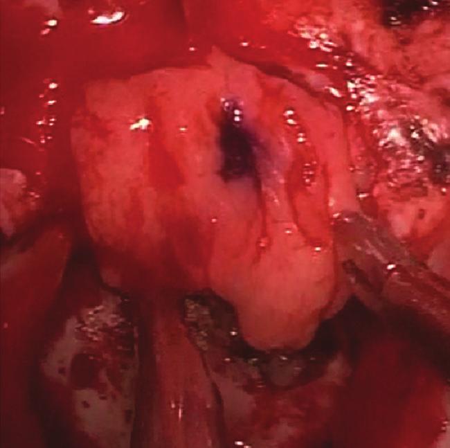 Neuroendoscopic view after removal of the PA, which was easy to remove.