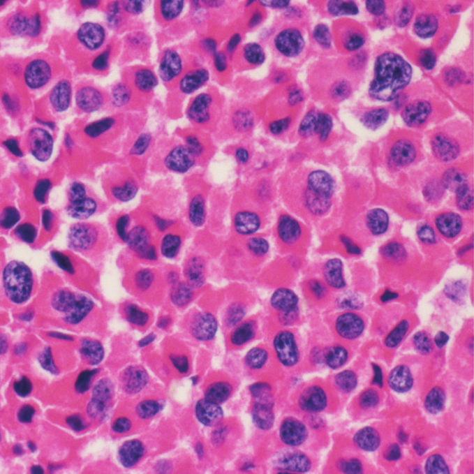 4 Case Reports in Neurological Medicine Figure 4: Photomicrograph shows the tumor is composed of monotonous eosinophilic cells. (H&E stain, original magnification 400.