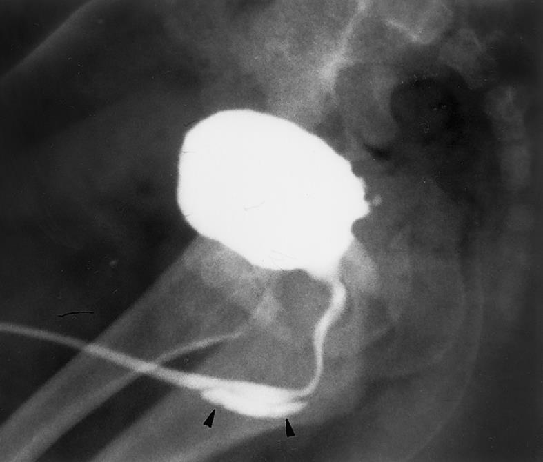 16. The X-ray above shows A. posterior urethral valves B. anterior urethral valves C. syringocele D. valve of Guerin 17. The incidence of reflux in offspring is A. 10% B. 30% C. 66% D. 90% 18.