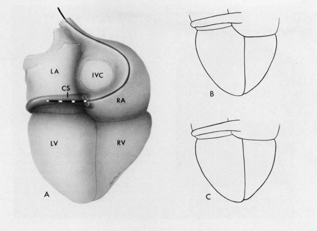 585 Sealy and Mikat: Identification and Interruption of Posterior Septa1 Kent Bundles Fig 1. Posterior aspect of the heart showing the area of the crux (adapted from McAlpine [Zl).