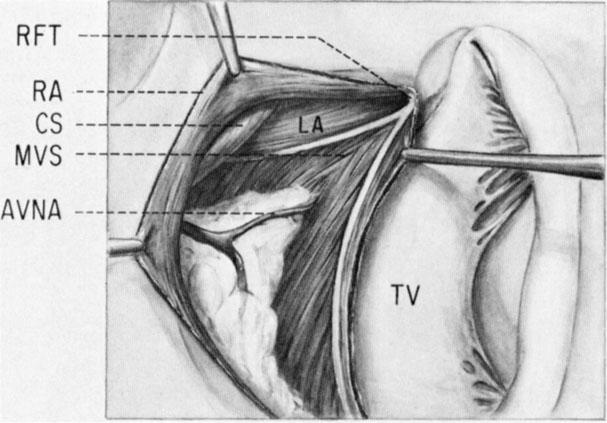 An incision has been made above the tricuspid annulus and will extend from the RFT to the right free wall as shown by the dashed lines. (Used by permission of Duke University Medical Center.) Fig 3.