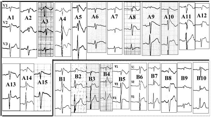 1732 Circulation September 28, 2004 Figure 1. ECG of study patients. Shown are leads V 1 through V 3 for all patients except patients A13 and A15, for whom only V 1 and V 2 are shown.