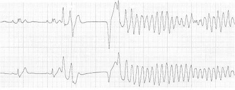 0.46 sec, and VF initiated by the second VPC, are shown. (B) VF was initiated by a VPC with coupling interval of 0.44 sec after a compensatory pause caused by a preceding VPC couplet.