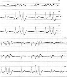 J Arrhythmia Vol 25 No 1 2009 A. 22:00 V 1 I 0.35s 0.35s II III 0.35s 0.35s V 2 av R V 3 av L av F V 4 V 5 B. 22:44 VPC VPC V 6 DC 30J 0.35s 0.35s Figure 4 The onset of VF in Case 3, as recorded on a 12-lead ECG and on the stored ECG from the ICD.