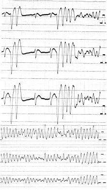 Before the onset, VPC couplets with an identical morphology to left bundle branch block and inferior axis were frequently observed.