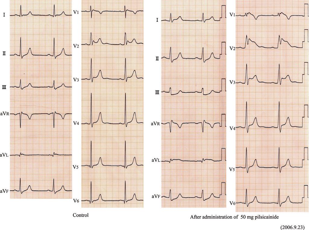 inducedbythepilsicainideprovocation. found to be positive on the signal-averaged ECG. In the coronary angiogram, no stenosis was detected.