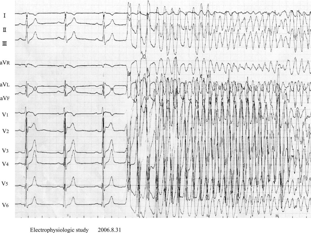 Figure3. Ventricularfibrilationinducedbycathetermanipulationintherightventricularout flowtract.
