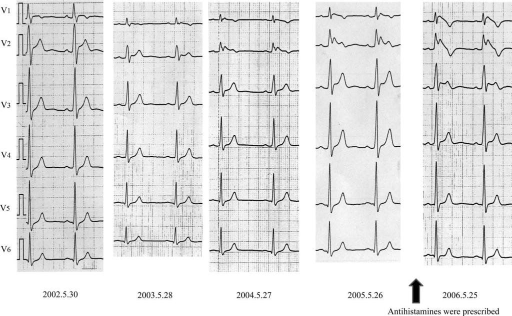 Asymptomatic Brugada syndrome case unmasked during dimenhydrinate infusion. J Cardiovasc Electrophysiol 12: 1192-1194, 2001. 3. Lopez-Barbeito B, Lluis M, Delgado V, et al.