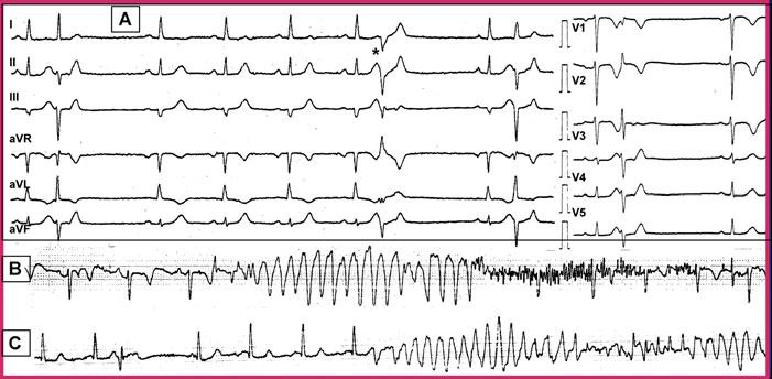 BELHASSEN, ET AL. Figure 1. ECG tracings obtained at hospital admission (November 24, 1997) of a 57-year-old woman with a history of multiple syncopes (no. 10) during the few weeks prior to admission.