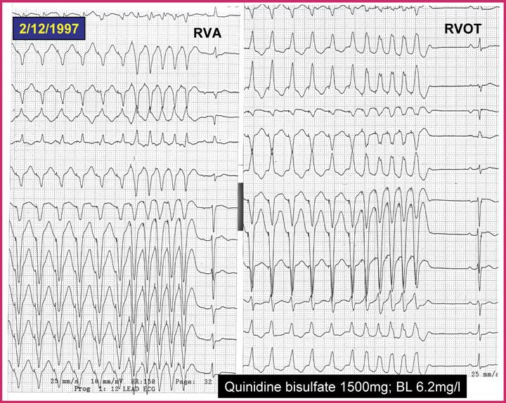 BELHASSEN, ET AL. Figure 3. Repeat electrophysiologic study after 1 week of treatment with quinidine bisulfate (1,500 mg/day).