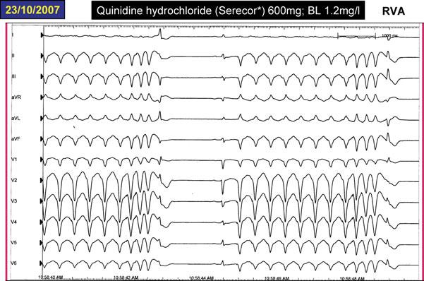 QUINIDINE FOR IDIOPATHIC VF AND BRUGADA SYNDROME Figure 4. Repeat electrophysiologic study performed approximately 10 years later during treatment with quinidine hydrochloride (600 mg/day).