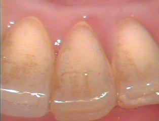 Figure 5: Images of the front teeth obtained with an intraoral camera (left) and with the fluorescence camera (right).