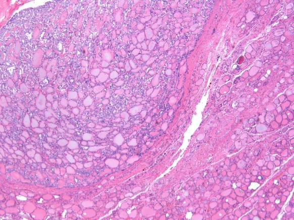 follicular neoplasm Nuclear features in NIFTPs are often more subtle,