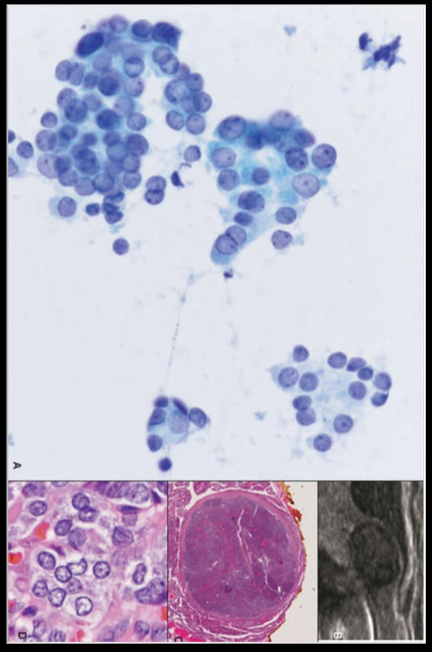 NIFTP-Cytology FNA cytology criteria Follicular pattern Nuclear features: Mild enlargement, elongation, pallor, overlap +/- Rare pseudoinclusions, grooves Absent: