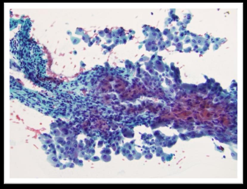 renal cell carcinoma Normal tissue fragments Seen in